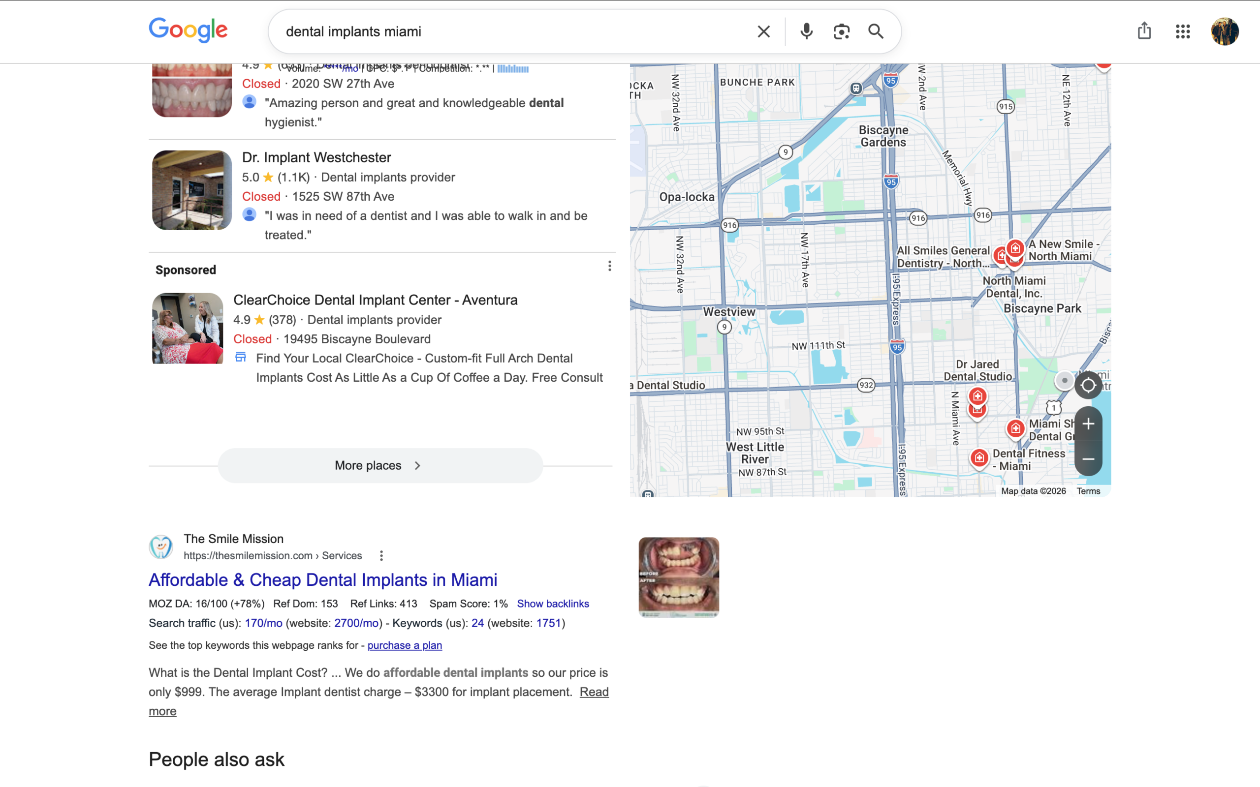 Google search results for dental implants Miami showing The Smile Mission ranking prominently